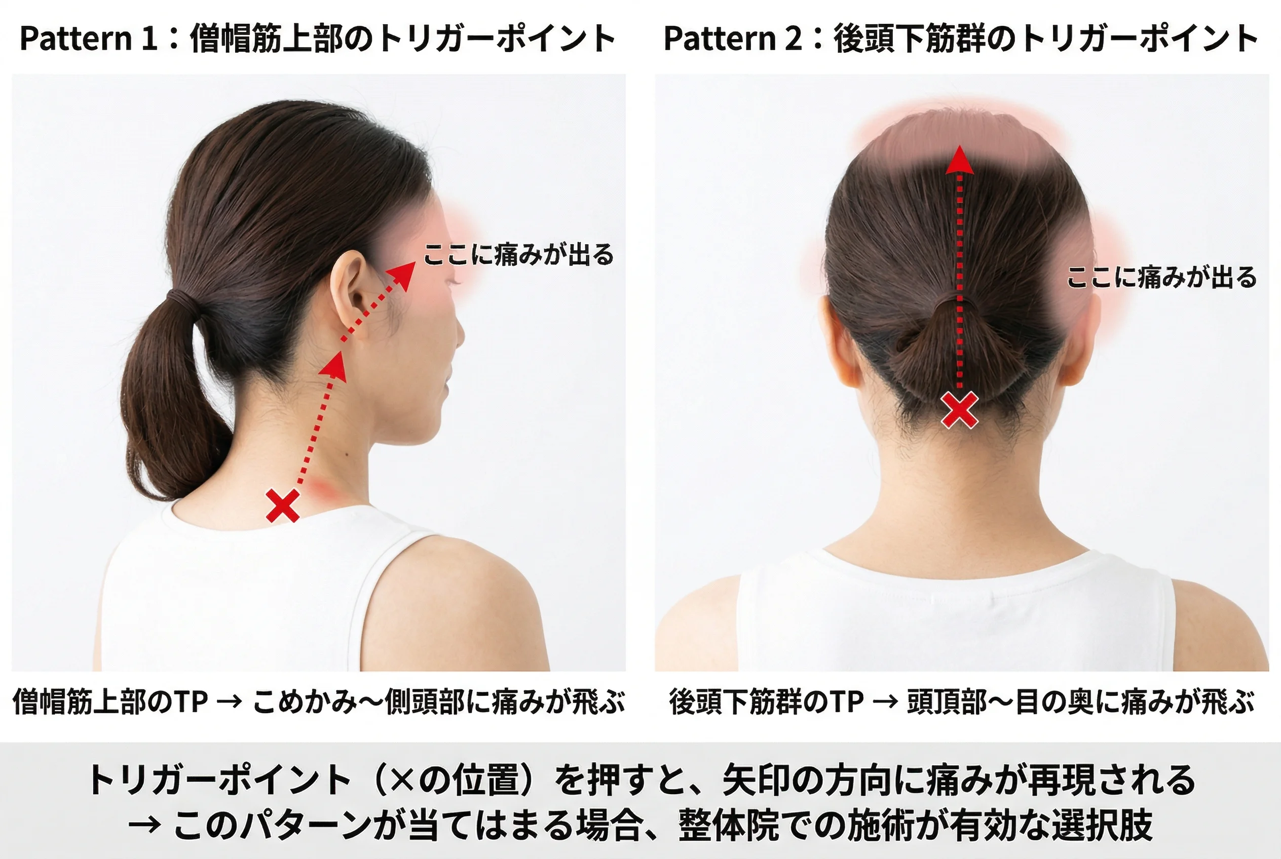 トリガーポイントから頭部への関連痛の走行図