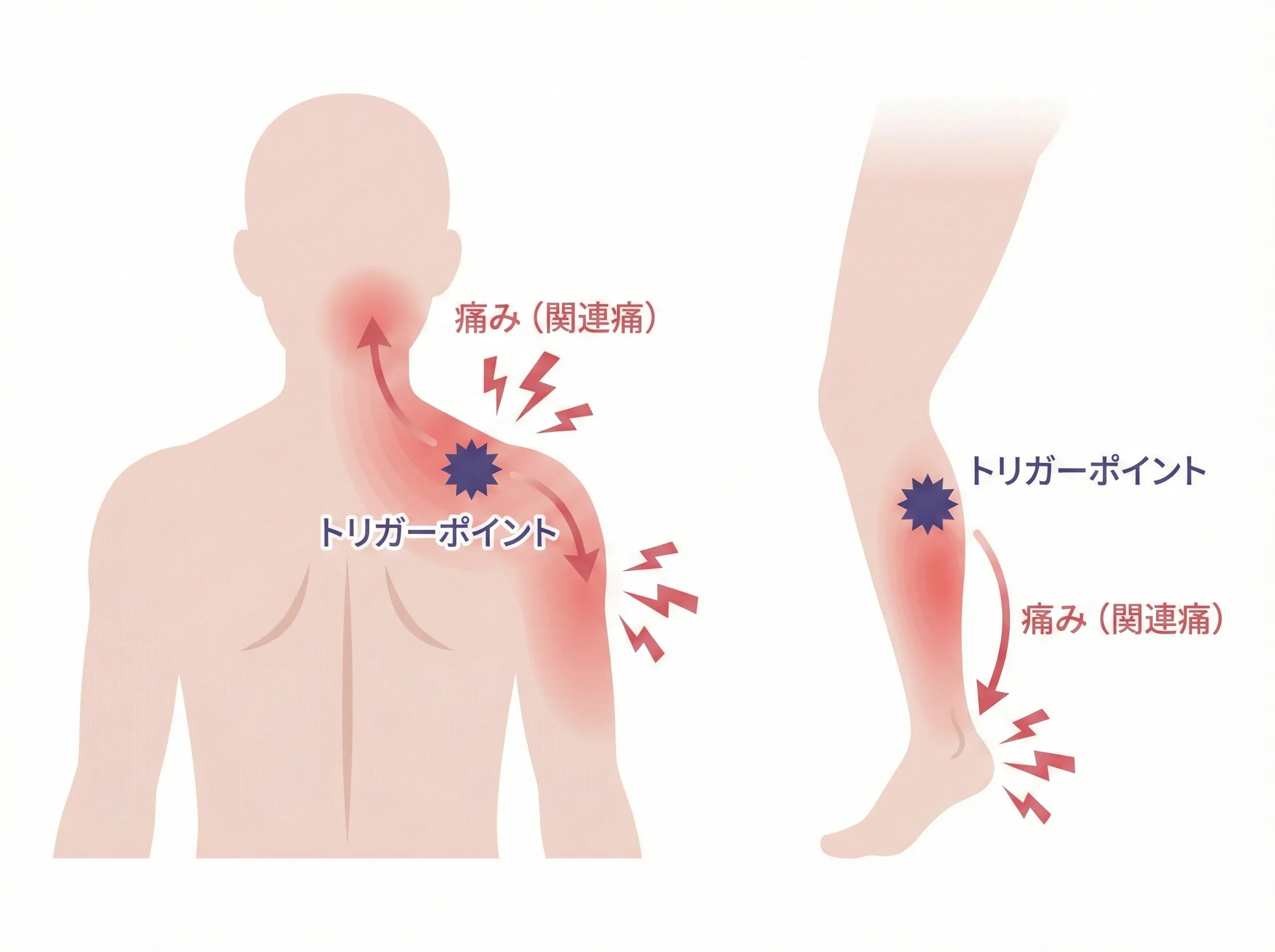 トリガーポイントによる関連痛パターンの図解：筋肉内の硬いしこりから離れた部位に痛みが放散する様子
