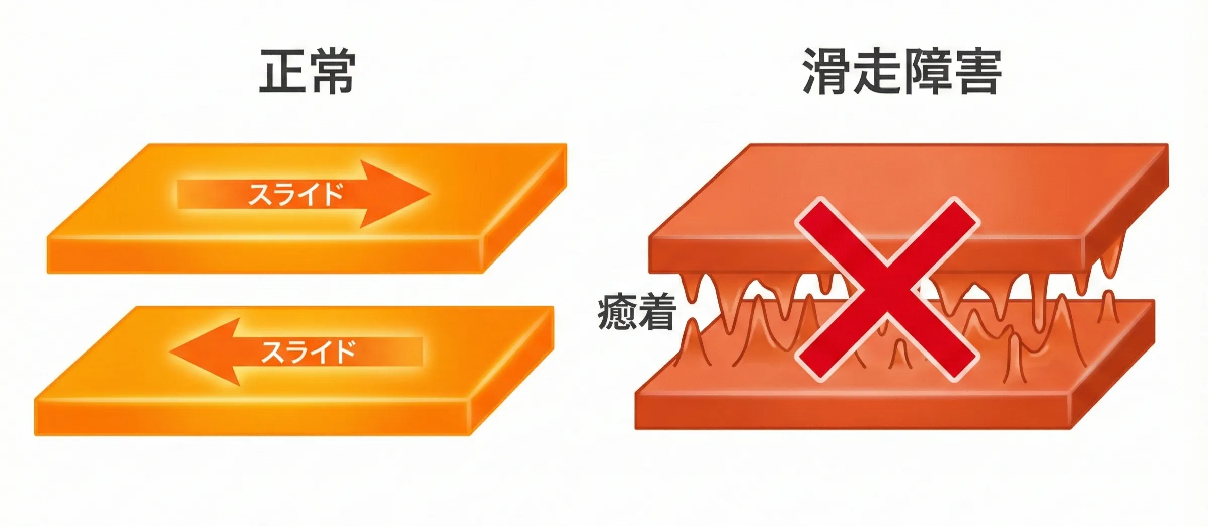 正常な滑走と滑走障害の比較：正常な状態では組織の各層がスムーズに滑走し、滑走障害の状態では層間の滑りが悪くなり引っかかりが生じている図解