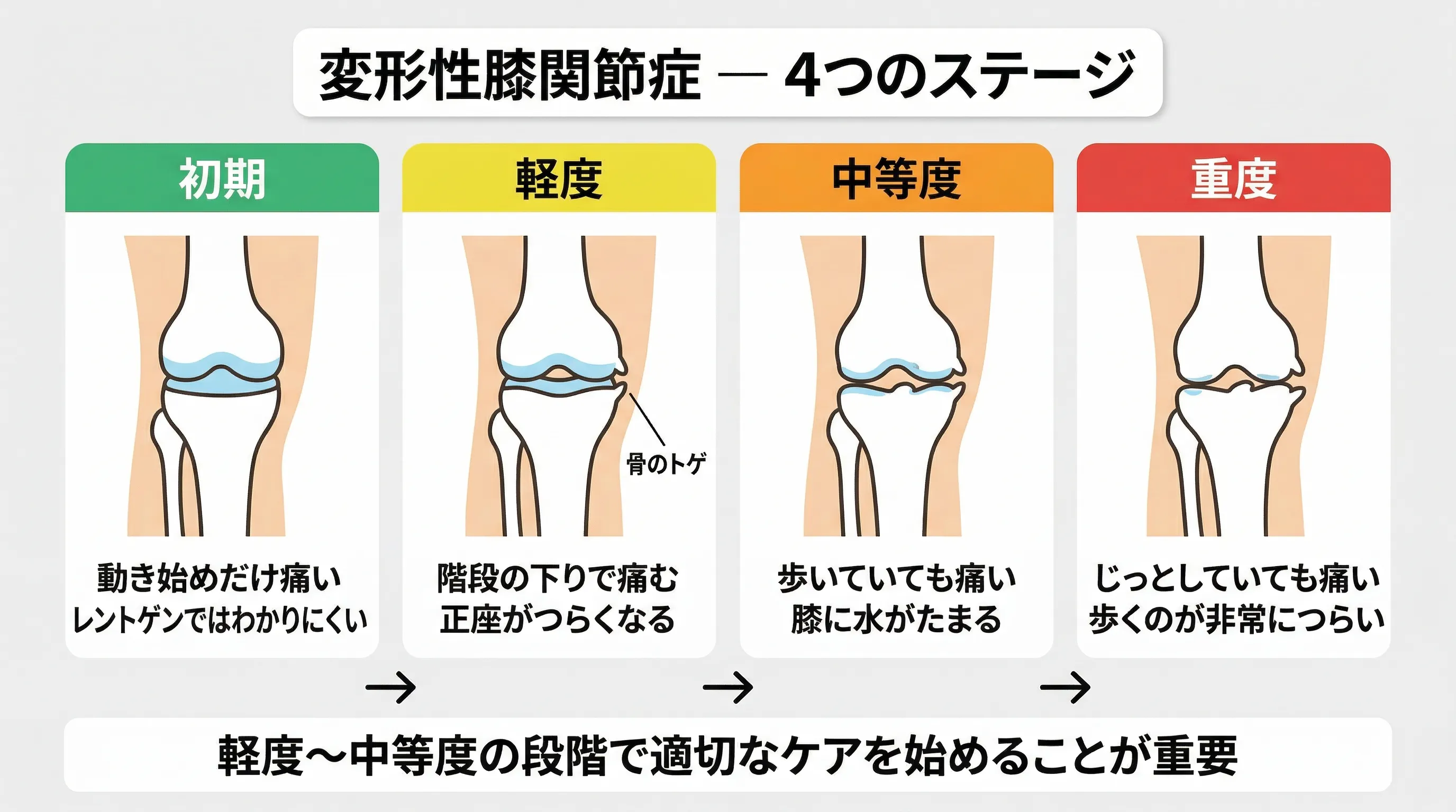 変形性膝関節症で知ってほしい3つのこと