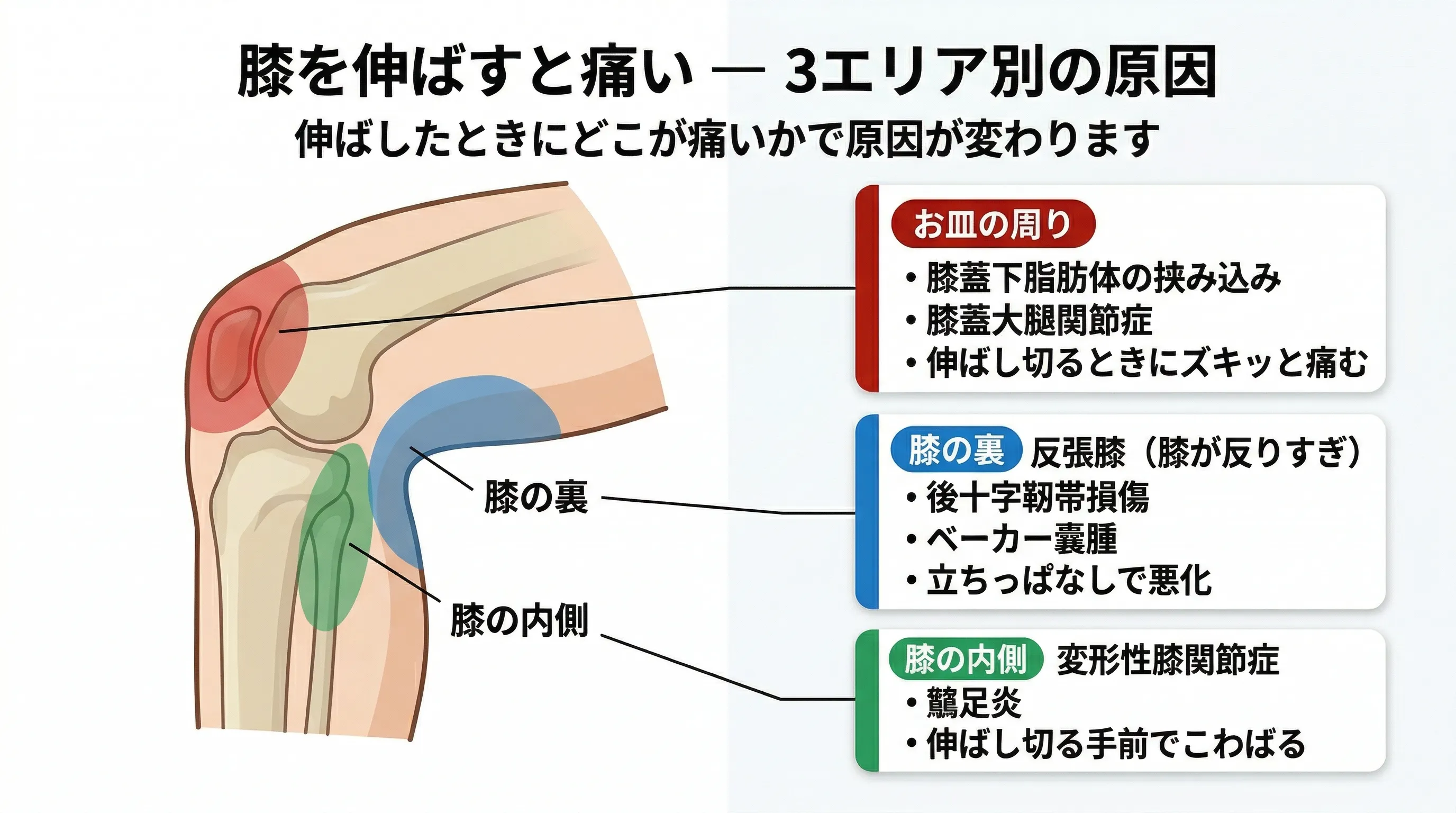 膝を伸ばすと痛い 3エリア別の原因マップ