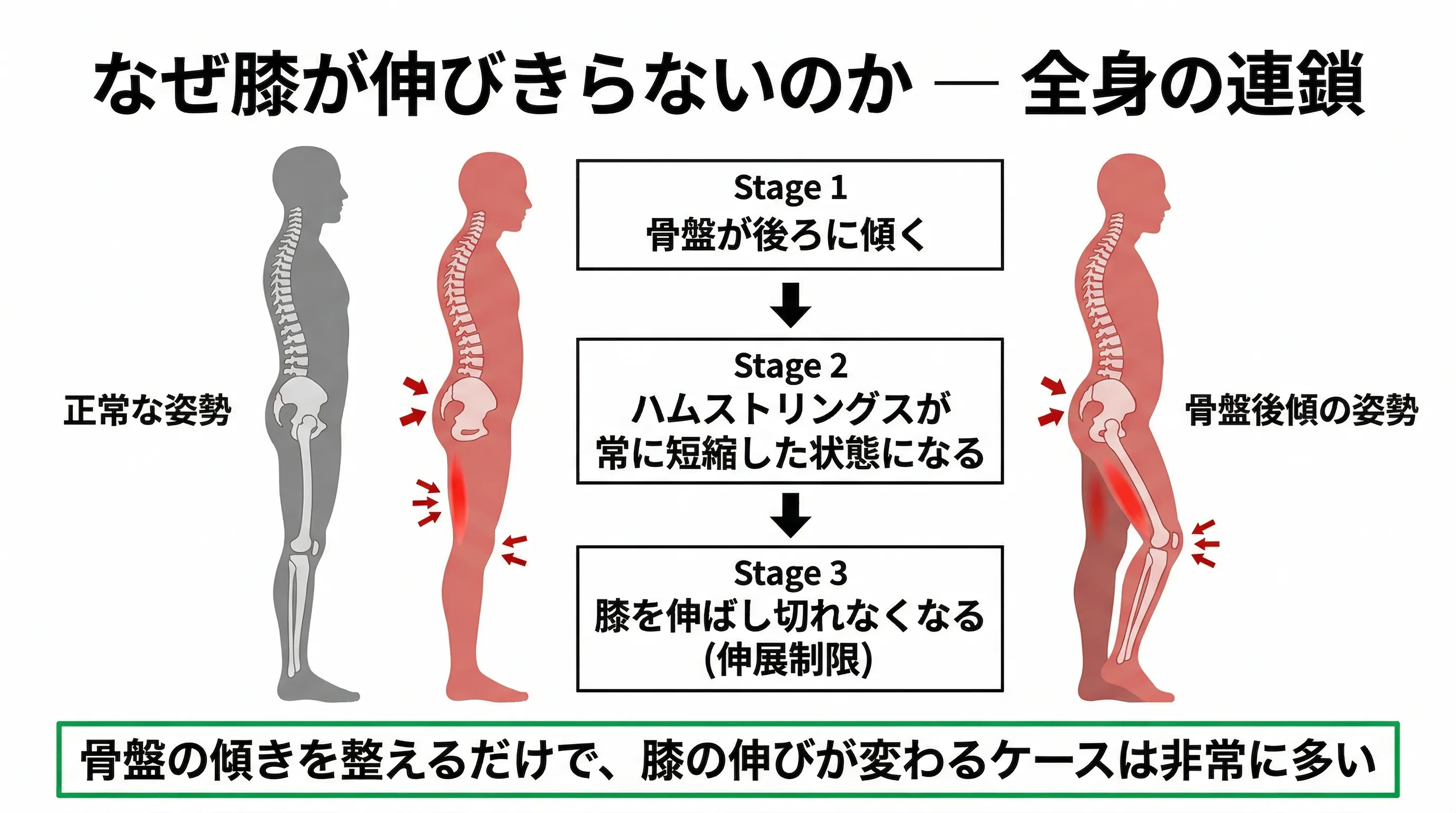 骨盤後傾から伸展制限の連鎖