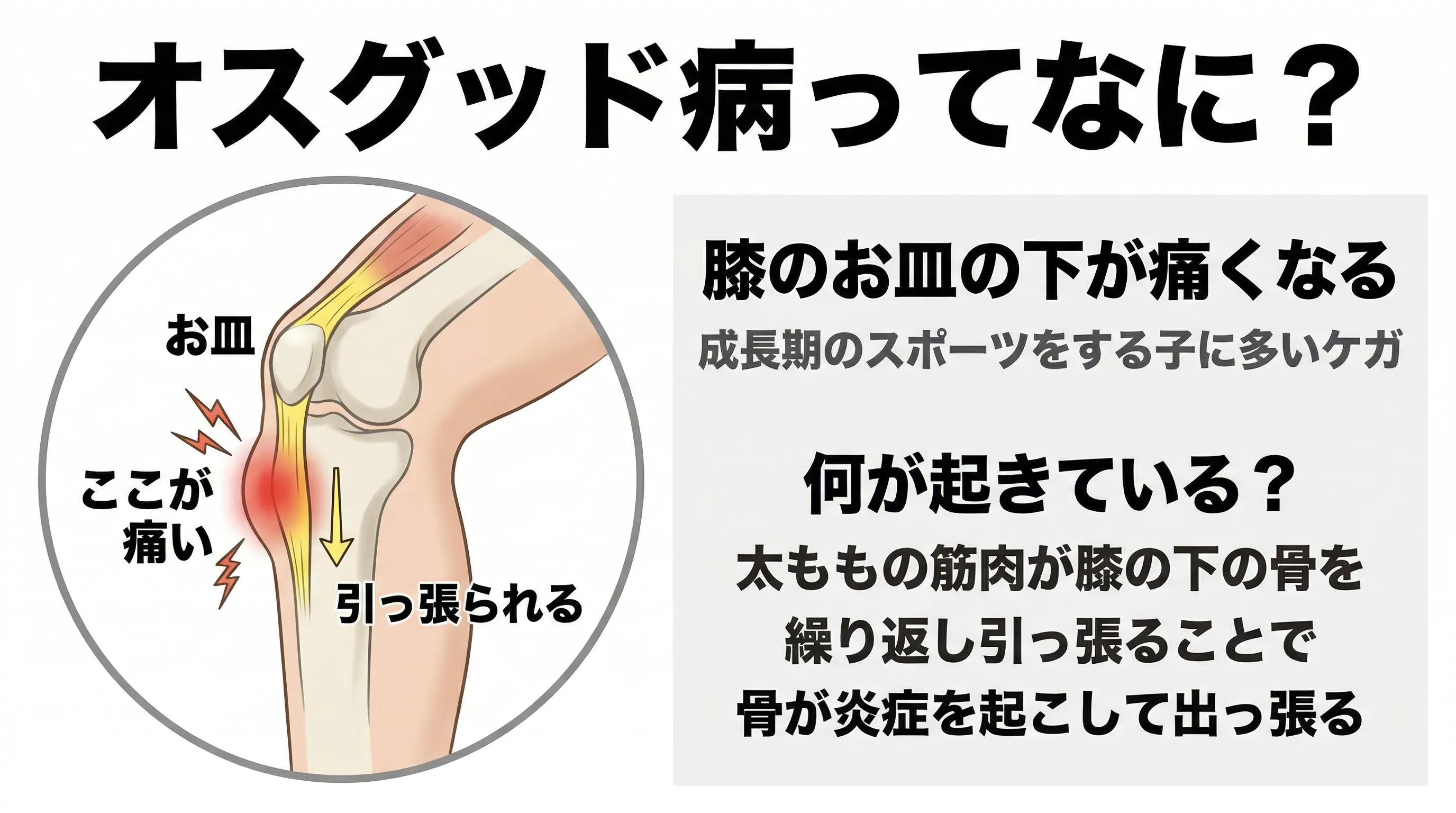 オスグッド病ってなに