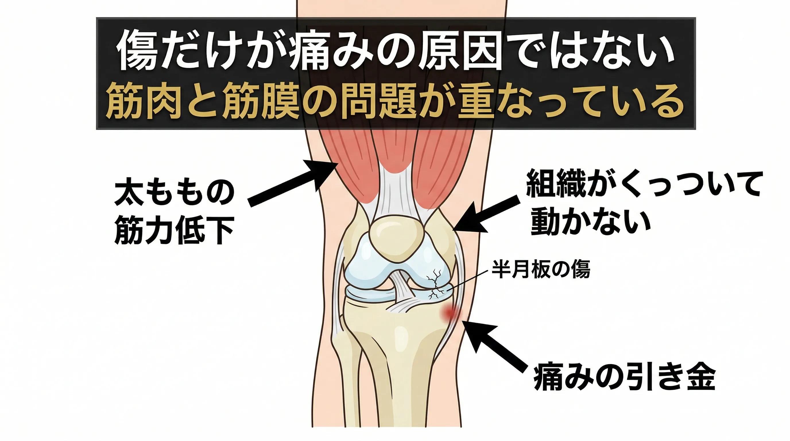 半月板だけではない痛みの原因