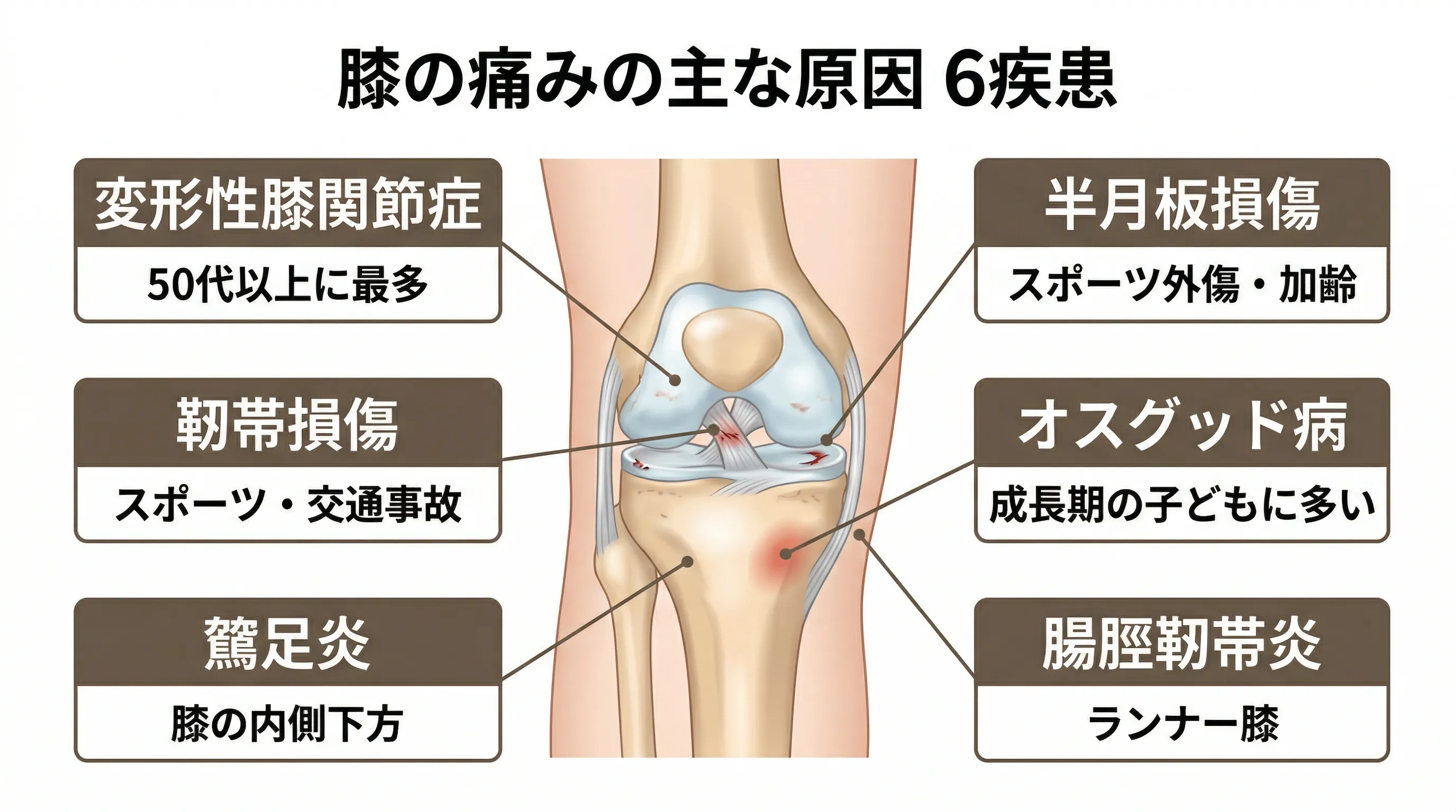 代表的な膝の6疾患の概要