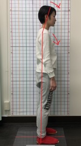 猫背矯正ビフォー2