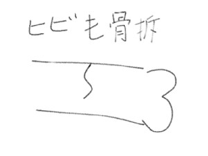 不全骨折（ヒビ）