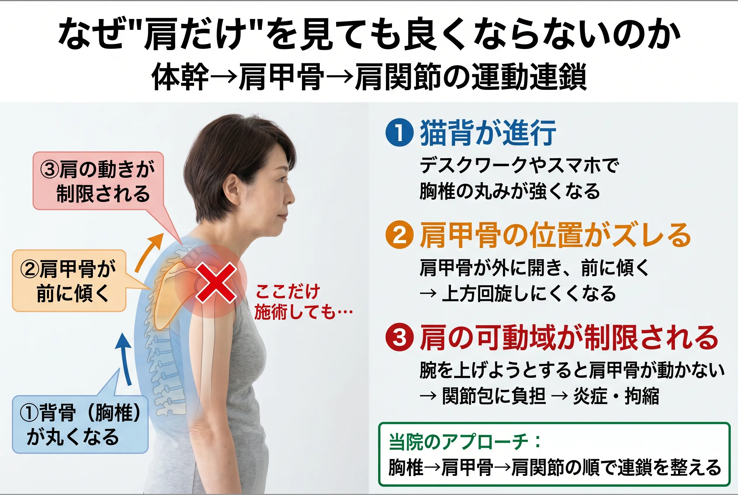 体幹→肩甲骨→肩関節の運動連鎖図：胸椎の丸まりが肩甲骨の前傾を生み、肩の可動域を制限する