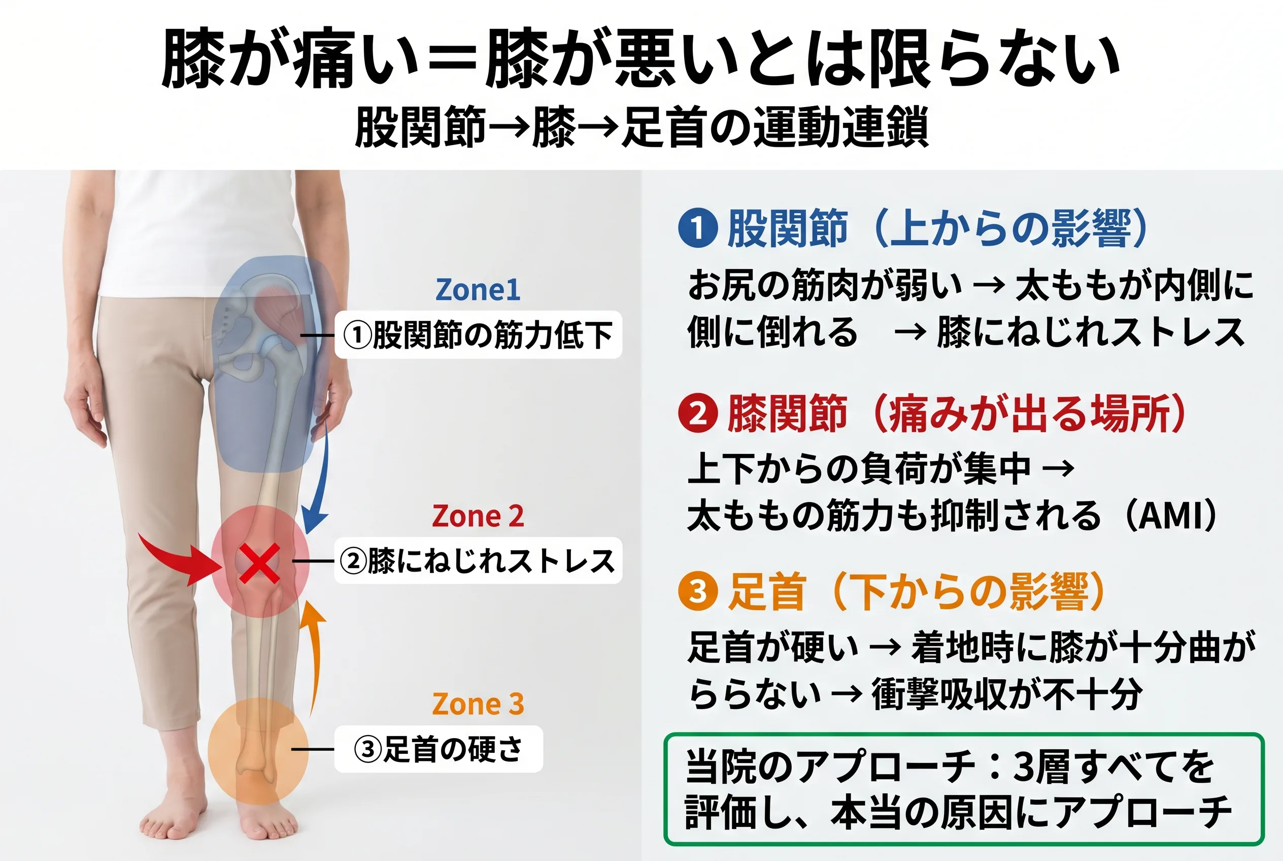 膝痛の3層構造（運動連鎖）図：股関節→膝→足首の連鎖で膝に負担が集中するメカニズム