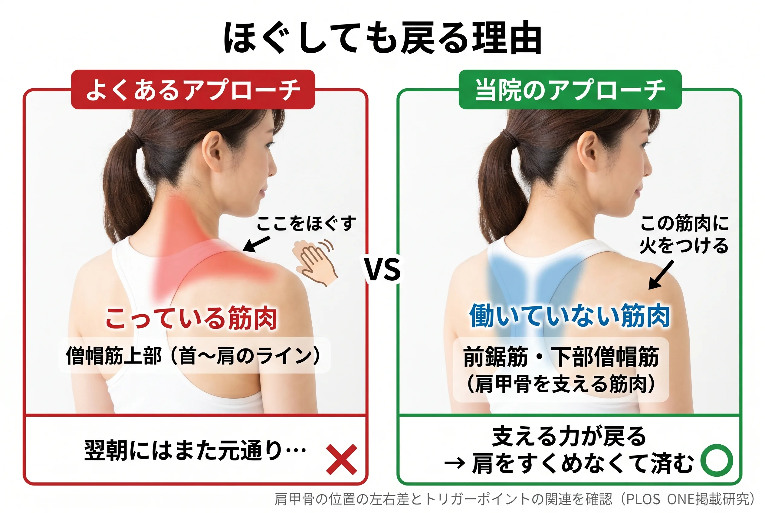 こっている筋肉vs働いていない筋肉の対比図：僧帽筋上部をほぐしても戻る理由と、前鋸筋・下部僧帽筋への当院アプローチ