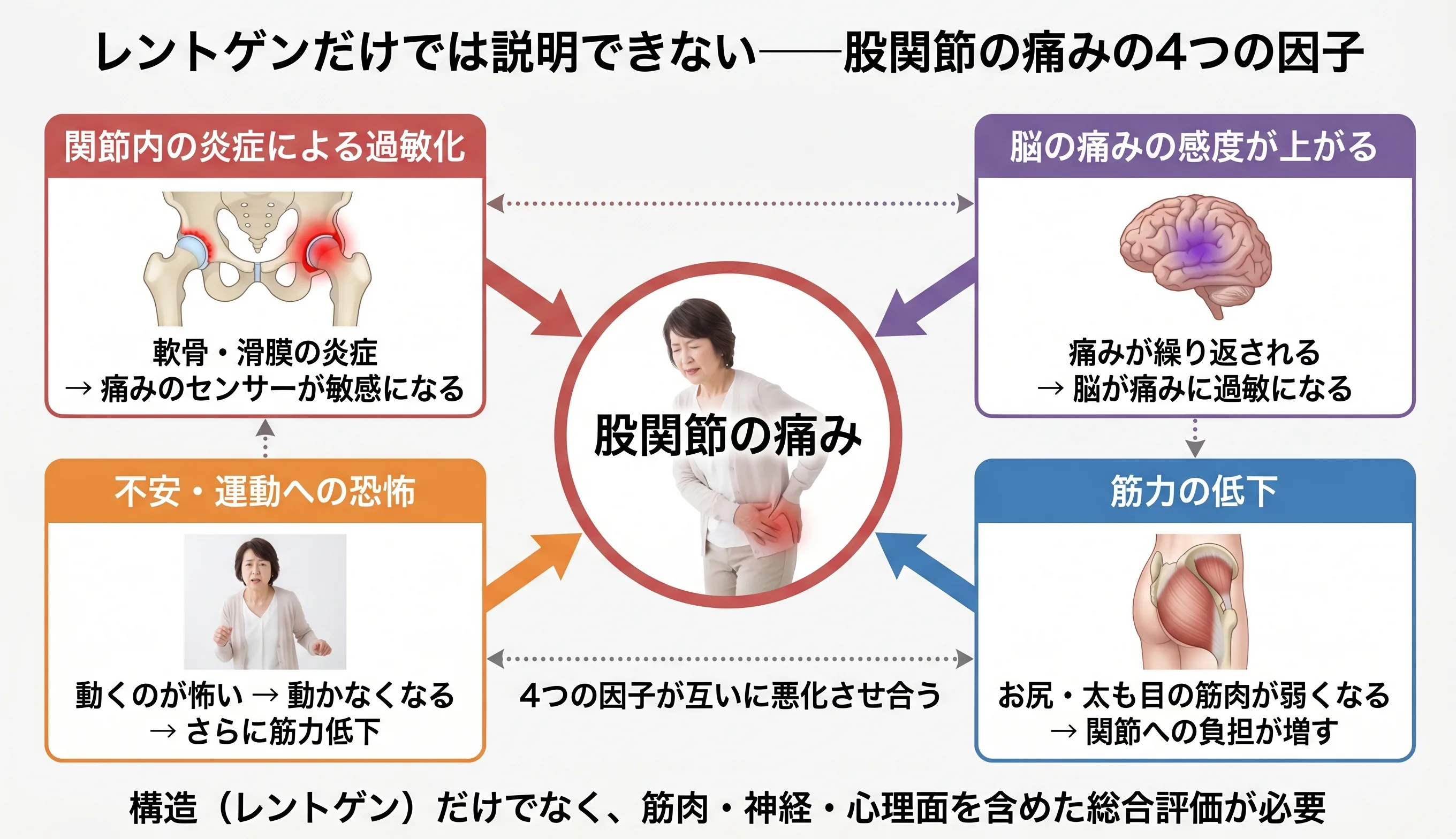 股関節の痛みの多因子モデル図：関節内の炎症・脳の過敏化・筋力低下・運動への恐怖の4因子