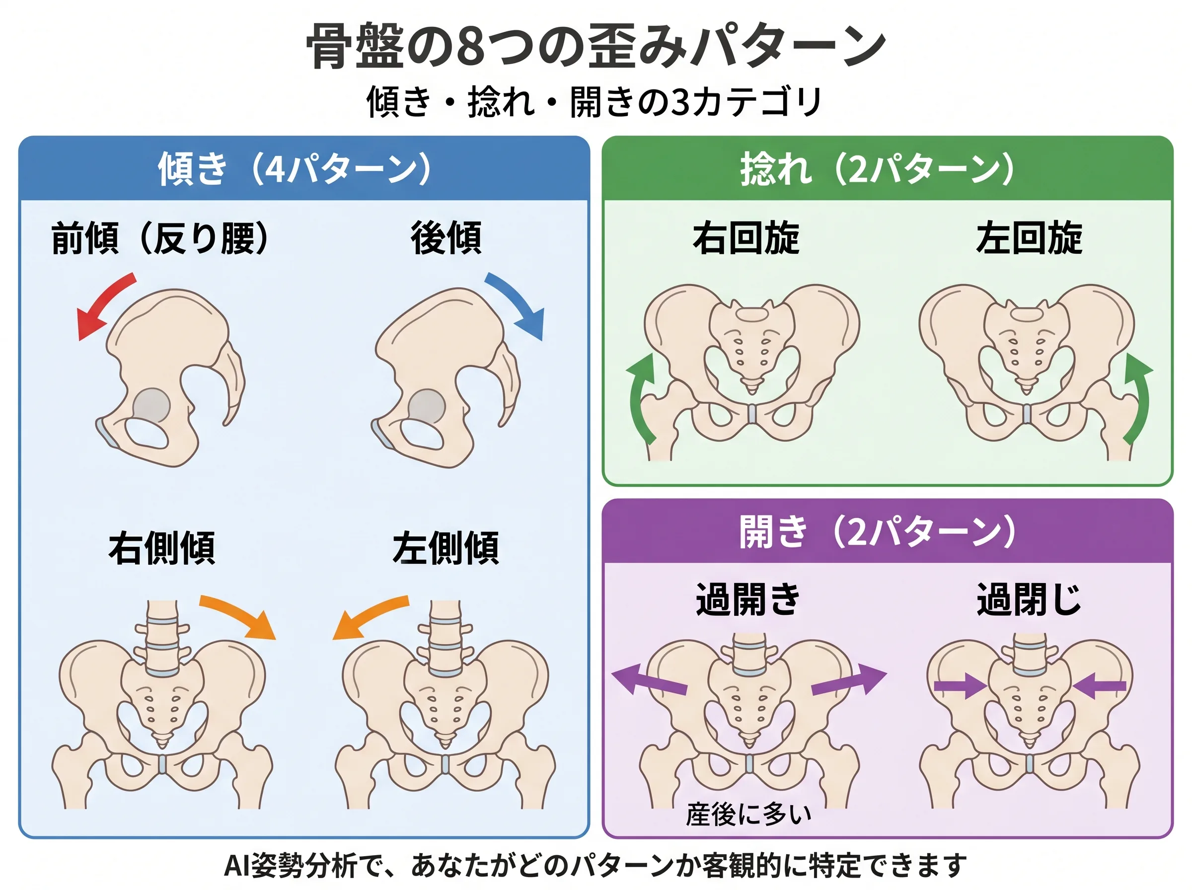 骨盤の8つの歪みパターン：傾き4パターン・捻れ2パターン・開き2パターンの分類図