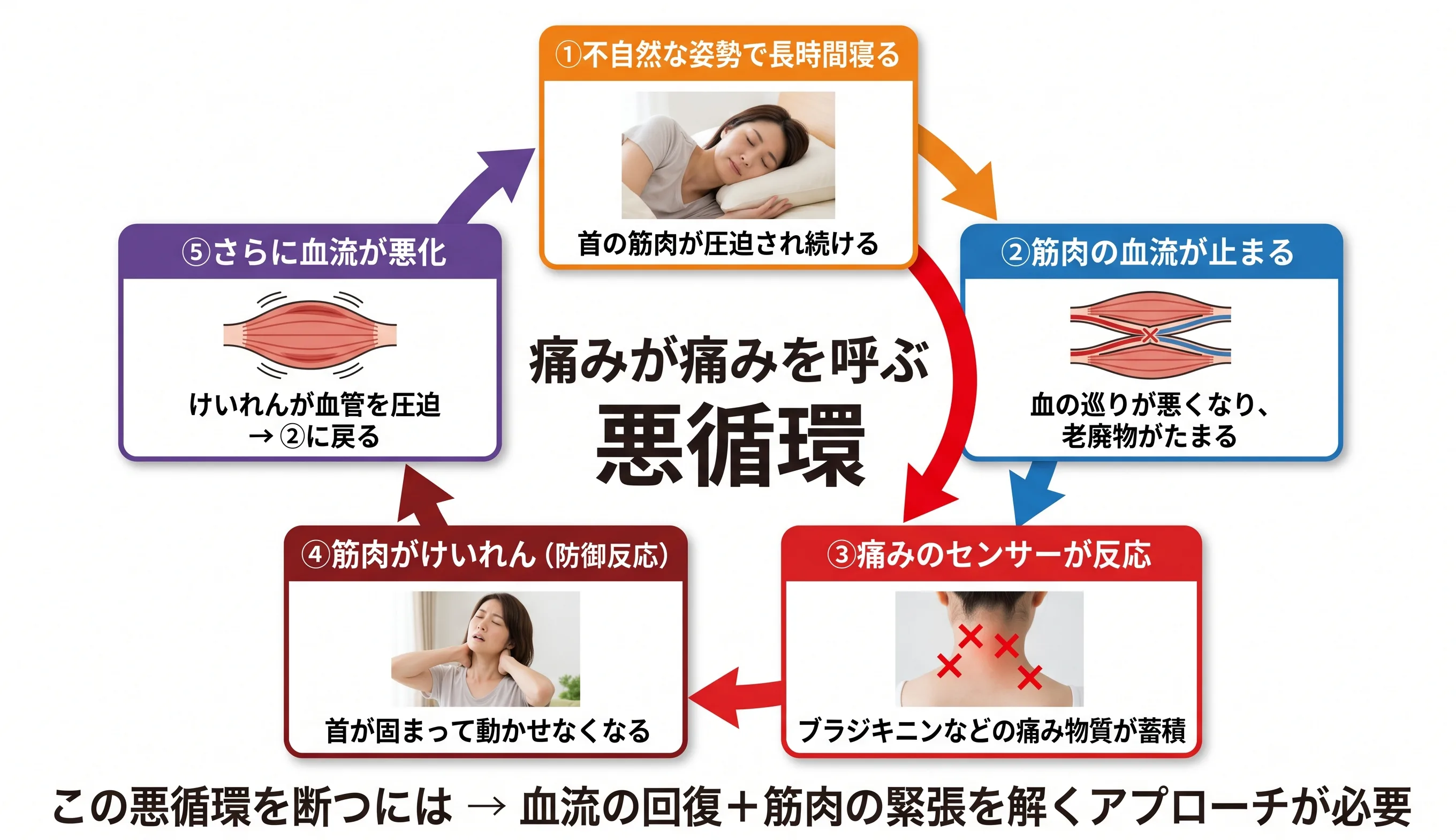 寝違えの悪循環メカニズム図：不自然な寝姿勢→血流停止→痛み物質蓄積→筋けいれん→さらなる血流悪化