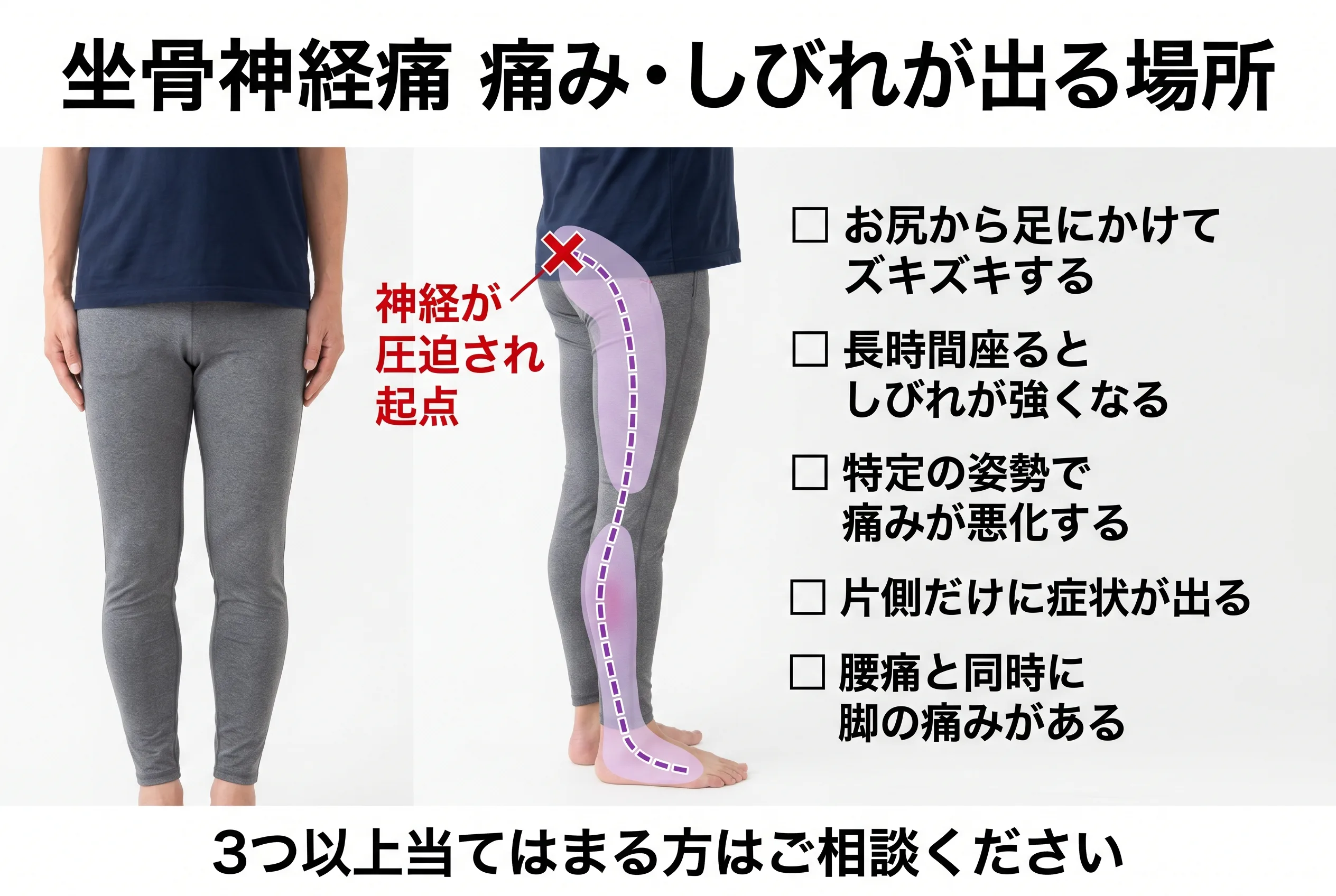坐骨神経痛 痛み・しびれが出る場所マップ：お尻から太もも裏・ふくらはぎ・足先までの神経走行