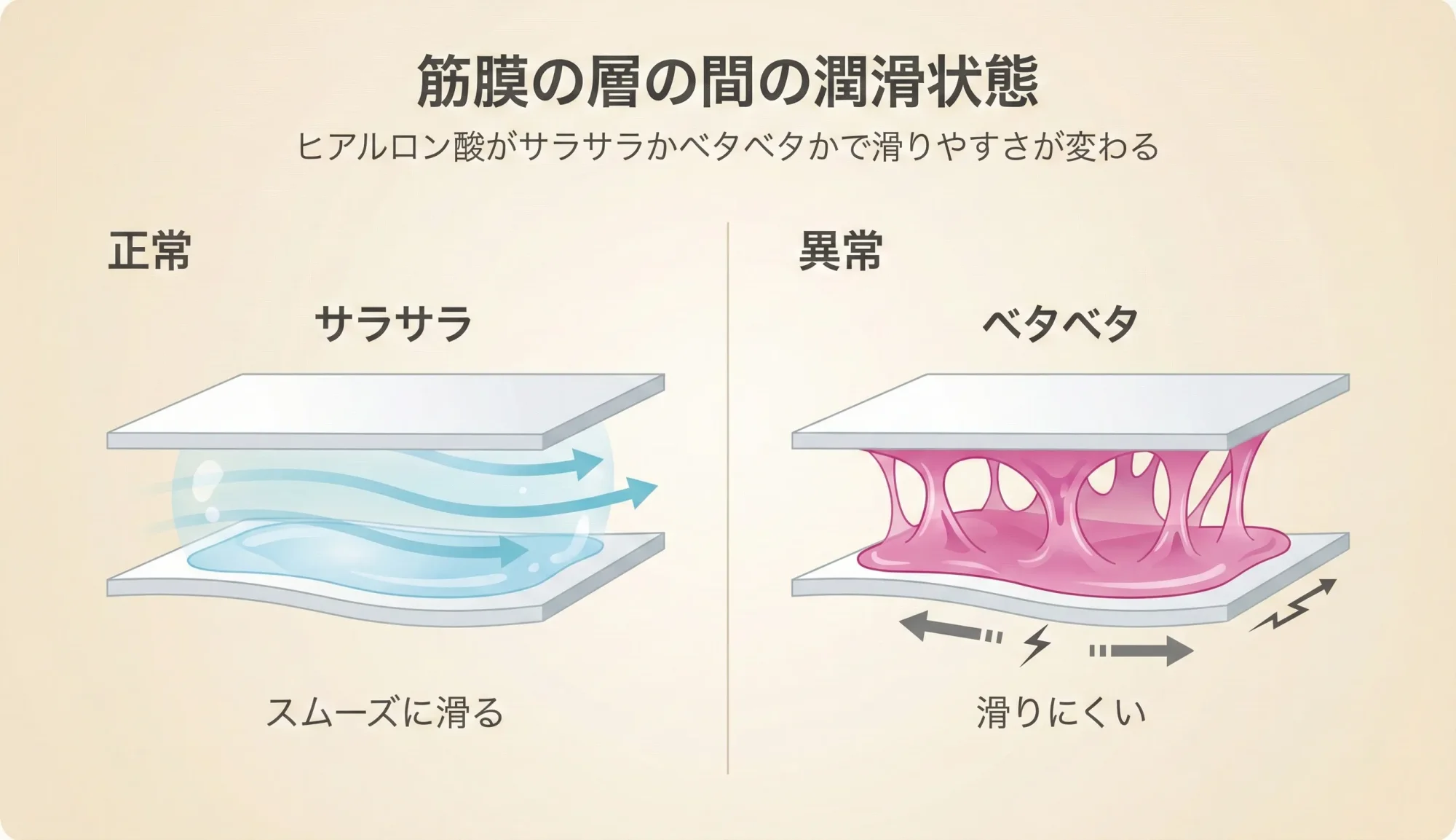 筋膜の滑走 - 正常な状態と癒着による滑走障害の比較図