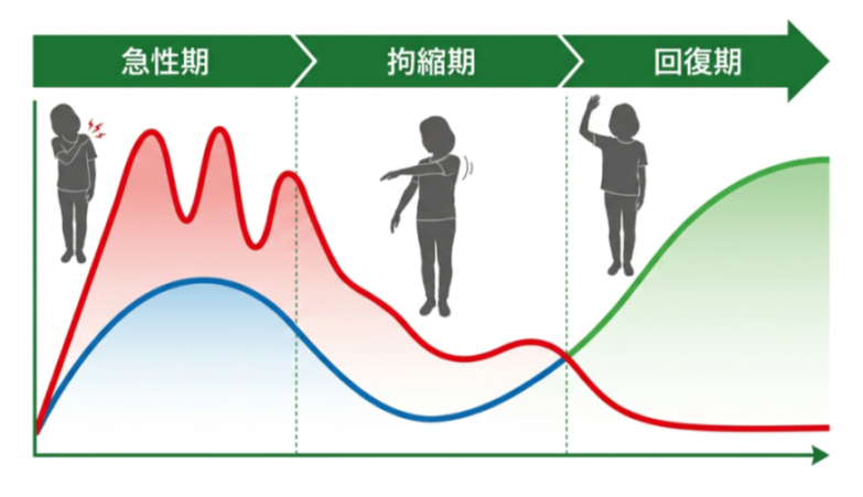 五十肩の全体像の図