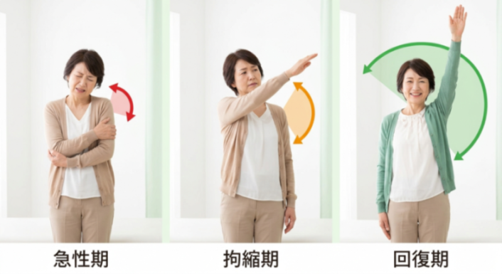 五十肩3タイプの比較図