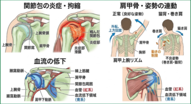 五十肩の仕組みの解説図