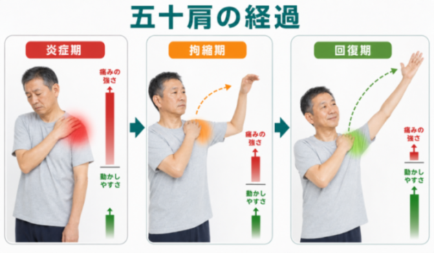 五十肩の経過（炎症期・拘縮期・回復期）の解説図